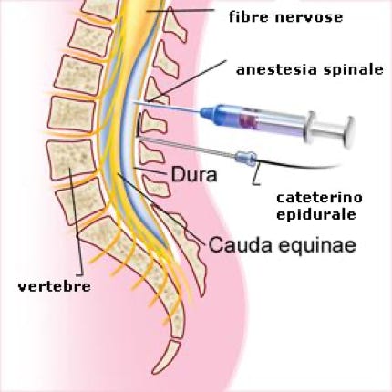 Collegamento al sito dell'Ospedale di B.Trento per vedere il corso dell'epidurale