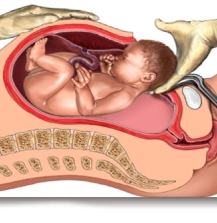 Il taglio cesareo dolce (gentle cesarean) o concentrato sulla famiglia